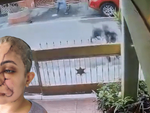 बेंगलुरु में पालतू कुत्ते का महिला पर हमला, video:चेहरे गर्दन पर काटा, 50 से ज्यादा टांके आए; बचाने आए युवक पर भी झपटा