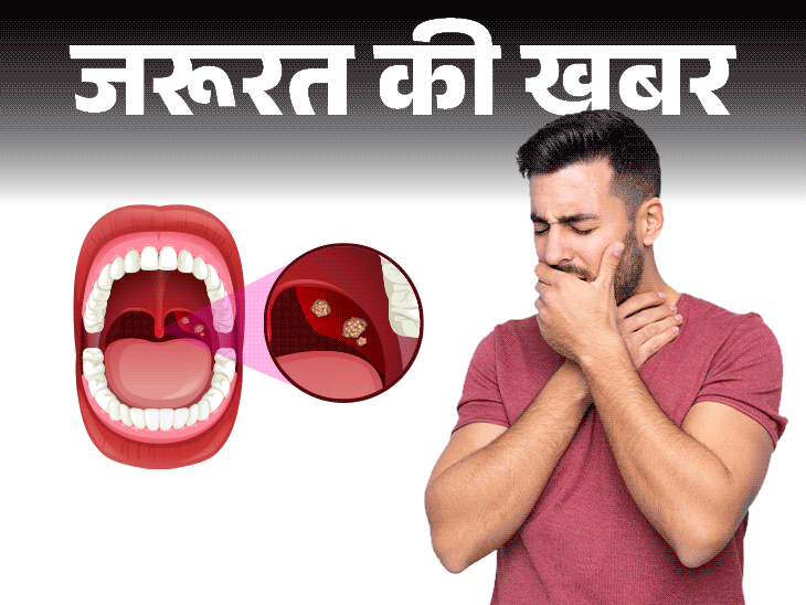 जरूरत की खबर गले में दर्द हो सकता है टॉन्सिलाइटिस:डॉक्टर से जानें ये क्या है, क्यों होता है, लक्षण और बचाव की जरूरी सावधानियां