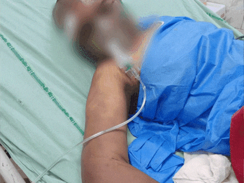 पुलिस अधिकारी की बेटी के प्राइवेट पार्ट सैनिटाइजर से जलाए:गुरुग्राम में लिव इन पार्टनर ने मारपीट कर न्यूड video बनाया, यूरिन पिलाया; bsc की छात्रा