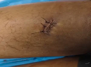 raipur chakubaji: रायपुर में फिर चाकूबाजी; युवती को लेकर विवाद में युवक पर हमला, आरोपी गिरफ्तार