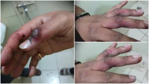 cg news: जेब में रखा मोबाइल फटा, बुरी तरह झुलसा युवक